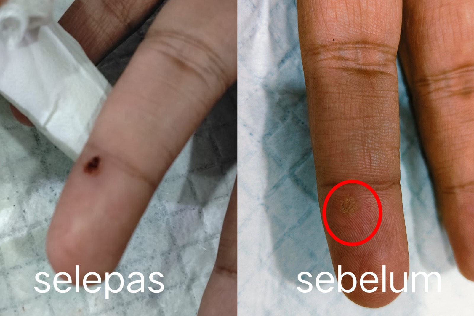 Buang ketuat di jari