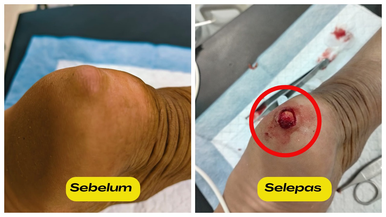 Buang sebacous cyst di tumit kaki
