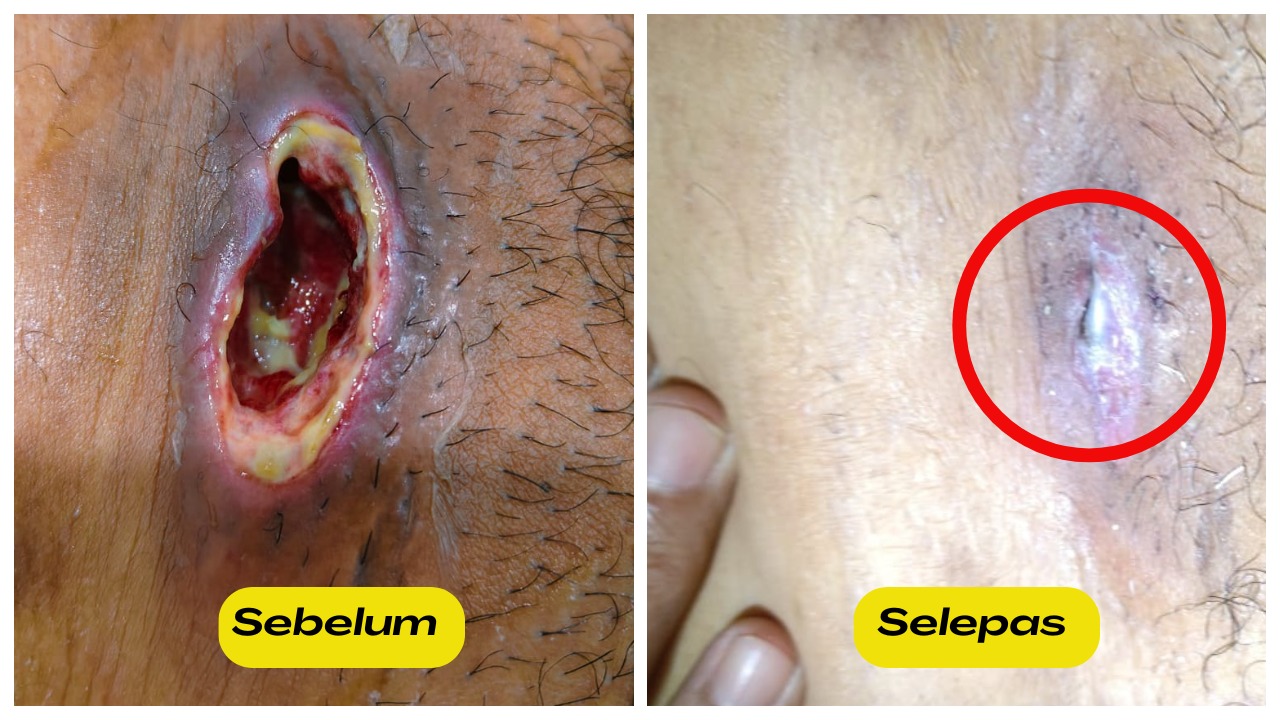 Luka pesakit diabetes di perut