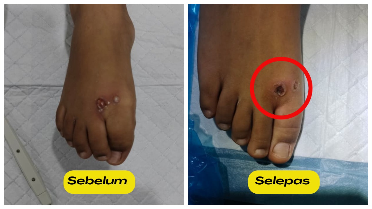 Buang ketuat di kaki