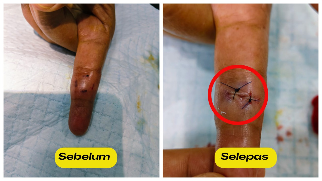Buang lipoma di jari